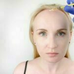 Hair Transplantation for Women